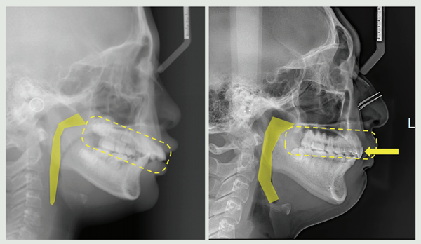 상악치열의 후방이동 후 기도공간의 변화를 연구한 결과 치열을 후방이동해도 기도공간은 좁아지지 않음이 입증됐다.