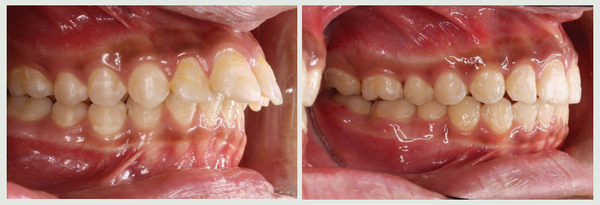 MCPP를 이용한 교정치료의 전후 비교 (돌출입 개선)