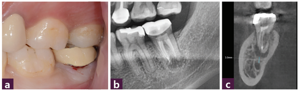 (그림 1) 술 전 사진   ⓐ 구강 내 사진  ⓑ 파노라마  ⓒ CBCT