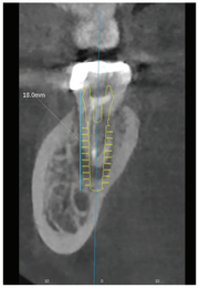 [그림 2] MagiCore를 이용한 18mm 식립 CBCT 시뮬레이션