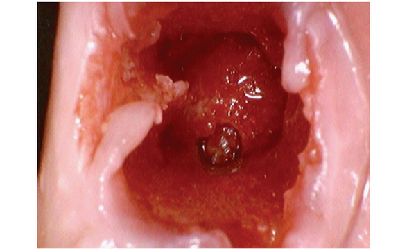 [그림 3] 발치 후 근심측에 식립구를 형성한 구강 내 사진