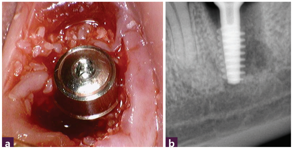 (그림 4) 식립 후 사진   ⓐ 구강 내  ⓑ standard 이미지