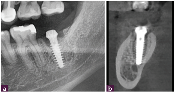 (그림 5) 식립 후 사진   ⓐ 파노라마  ⓑ CBCT