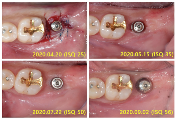 (그림 6) 37번 연조직 치유과정 중 ISQ 수치 변화