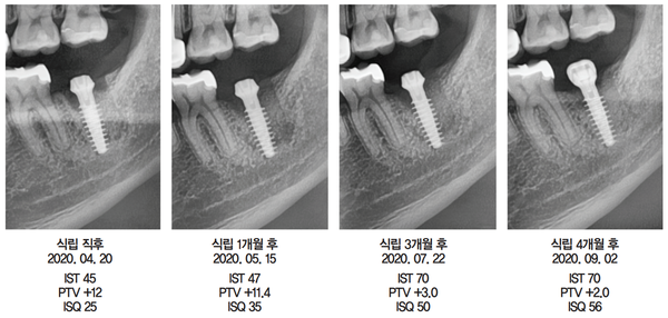 (그림 7) 술 후 4개월간 ISQ 수치 변화와 파노라마