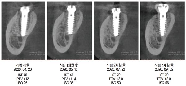 [그림 8] 술 후 4개월간 ISQ 수치 변화와 CBCT