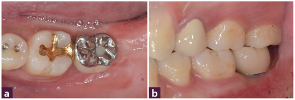 (그림 9) 37번 식립 4개월 후 최종 보철 장착 구강 내 사진   ⓐ 교합면  ⓑ 협측면