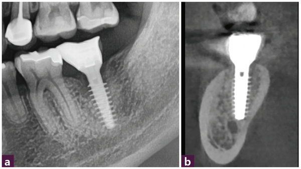 (그림 10) 식립 4개월 후 최종 보철 장착 사진   ⓐ 파노라마  ⓑ CBCT
