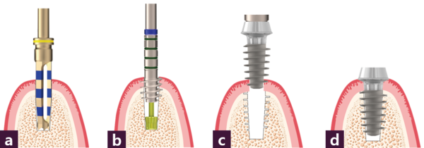 [그림3] ⓐ~ⓑ MFD, ⓒ~ⓓ MF