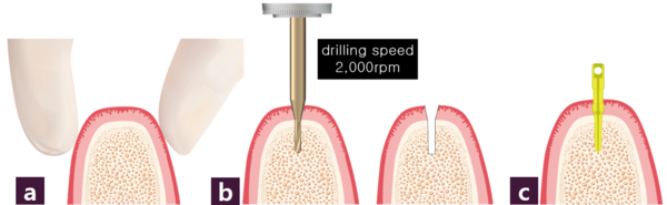 [그림 4] Magic Guide Pin 설치 과정 ⓐ 식립 부위 치조정 촉진 ⓑ GPS Drilling ⓒ Magic Guide Pin 삽입