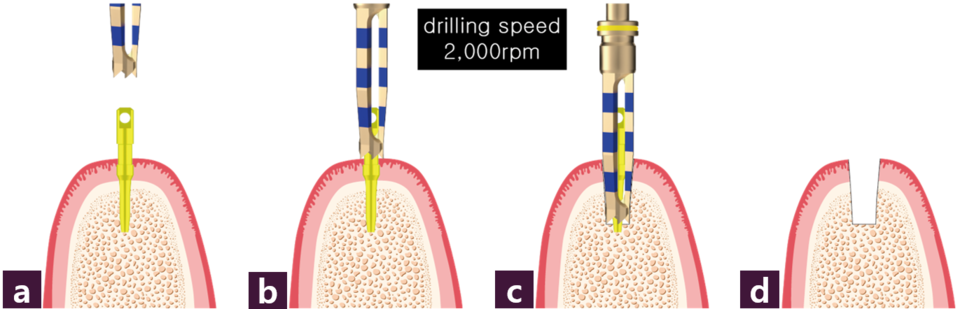 [그림 5] 1st body preparationⓐ~ⓒ Magic Guide Pin을 물고 Magic Drill을 일부 진입시켜 path 확인 ⓓ Magic Guide Pin과 Magic Drill 제거