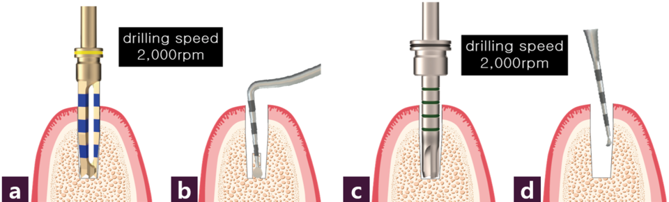 [그림 6] 2nd body preparation ⓐ 전체 식립구 깊이까지 drilling ⓑ 내부 bone core 제거, ⓒ~ⓓ Magic Depth Drill을 이용해 식립구 바닥 다듬고 확인