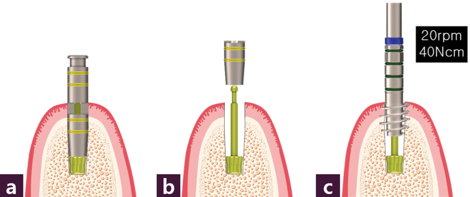 [그림 7] Thread preparationⓐ Magic Tap Guide 삽입 ⓑ Magic Tap Body 제거 ⓒ 식립구 path를 따라 Magic Tap Drill 적용