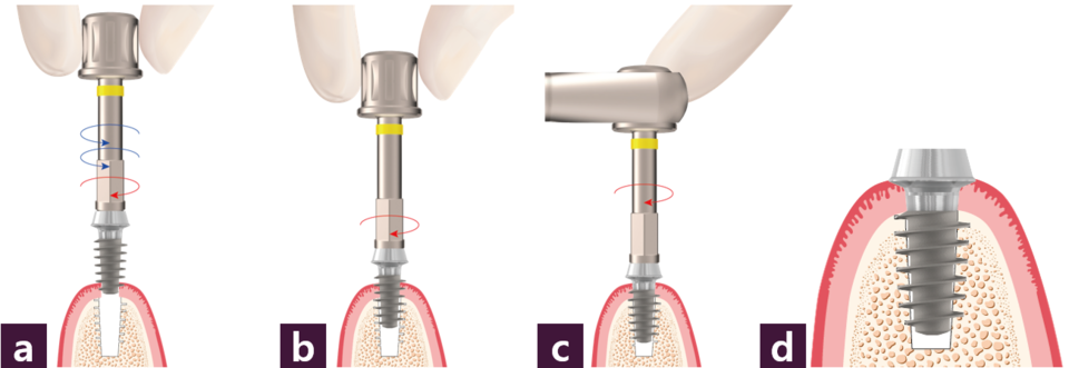 [그림 8] Magic Fit Implantationⓐ 만들어진 나사산 찾기 ⓑ 정방향으로 돌리며 식립 ⓒ torque wrench를 사용하여 식립 ⓓ 식립이 완료된 모식도