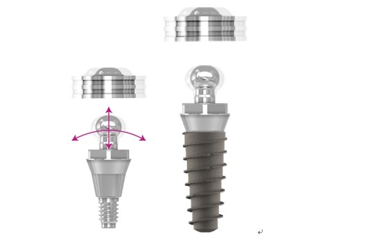 IBS가 출시한 새로운 개념의 오버덴쳐시스템 매직모션