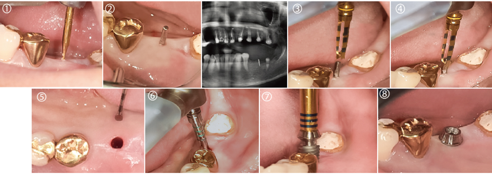 그림 2] Magic GPS의 임상 적용① Magic GPS Drill 사용 ② Magic Guide Pin 설치 후 방사선 촬영 & 평가 ③~④ Magic Guide Pin을 따라 Magic Drill 사용⑤ 형성된 식립구 ⑥ 식립구 바닥 정리 ⑦ MagiCore 식립 ⑧ 식립 완료