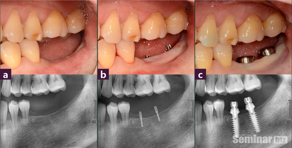 [그림 3] 측면 photo & pano ⓐ 술 전, ⓑ Magic GPS, ⓒ 술 후