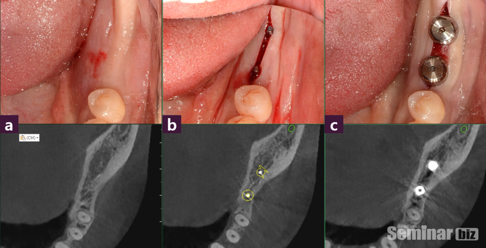 [그림 4] 교합면 photo & CT axial view (a) 술 전, (b) Magic GPS, (c) 술 후