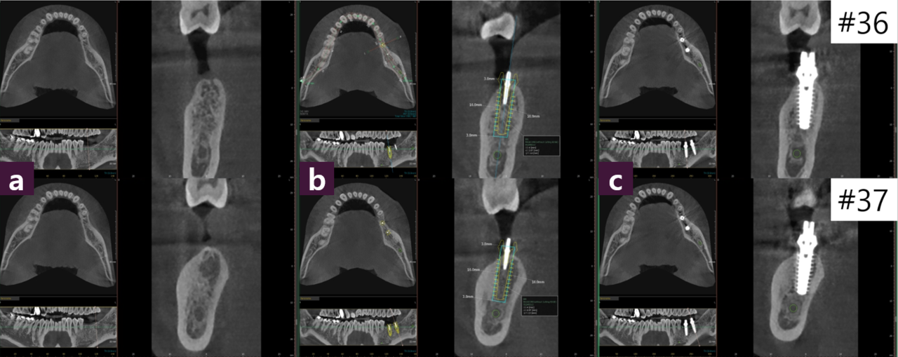 [그림 5] #36, 37 CT view ⓐ 술 전, ⓑ Magic GPS, ⓒ 술 후