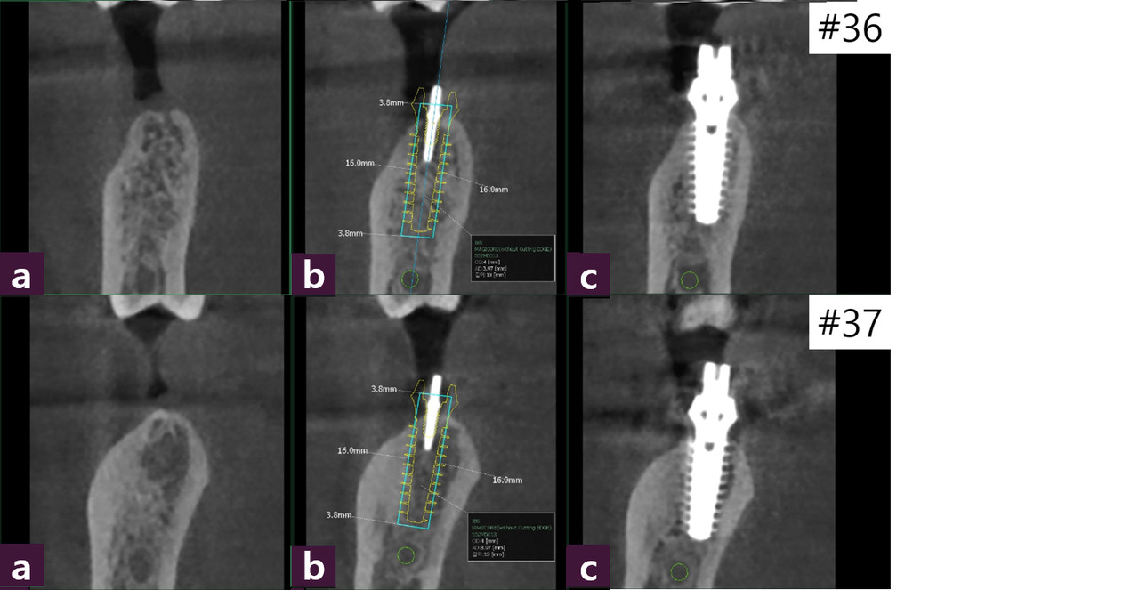 [그림 6] #36, 37 CT view ⓐ 술 전, ⓑ Magic GPS, ⓒ 술 후