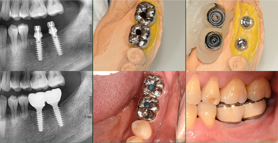 [그림 8] 최종 보철 setting (2020.9.17), 술후2개월