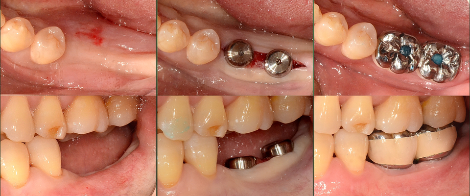[그림 9] Gingival expansion 술 전/후 (2020.7.16) & 최종 보철 (2020.9.17) photo