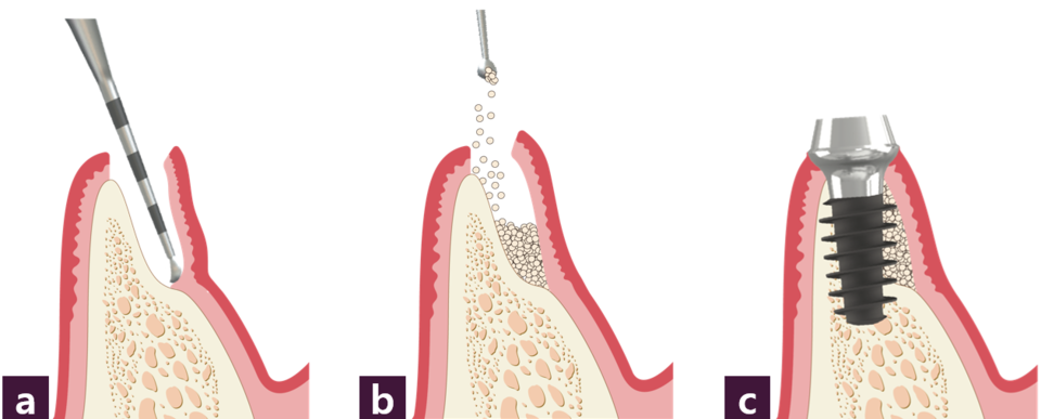[그림 1] External pocket technique의 모식도ⓐ 최소한의 절개를 통해 협측으로 작은 주머니 형성, ⓑ 골이식 시행, ⓒ MagiCore 식립
