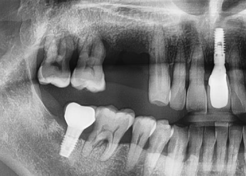 [그림 2] 술 전 파노라마