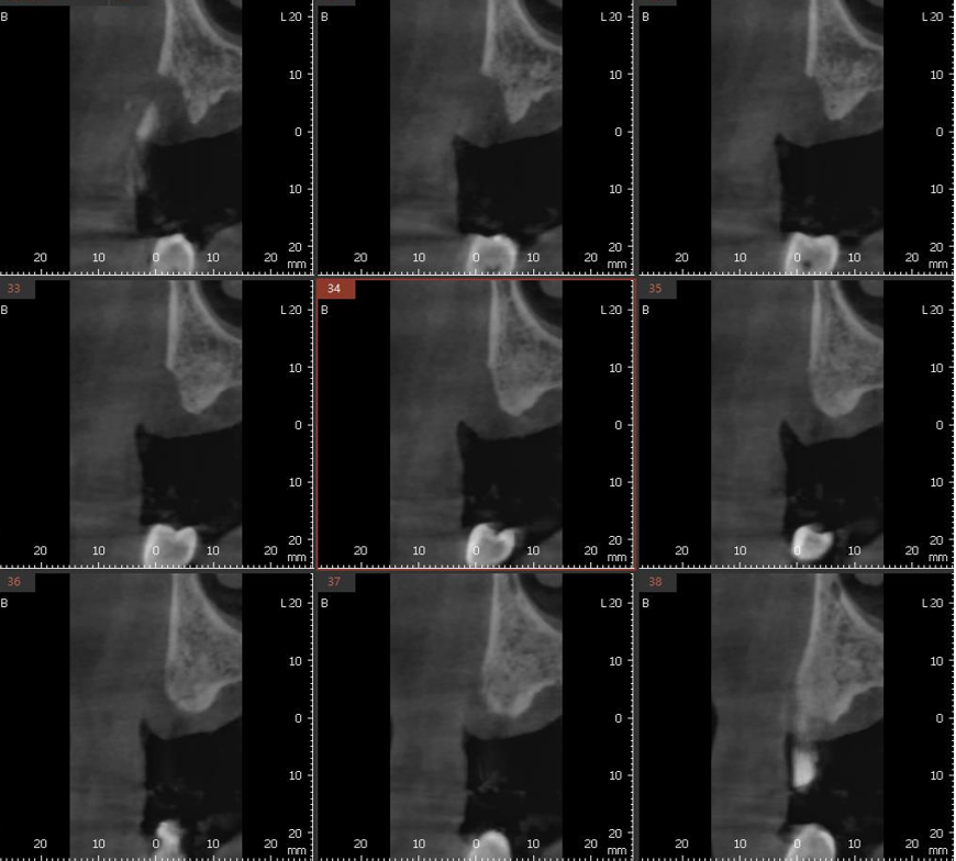 [그림 3] #14 부위 CBCT