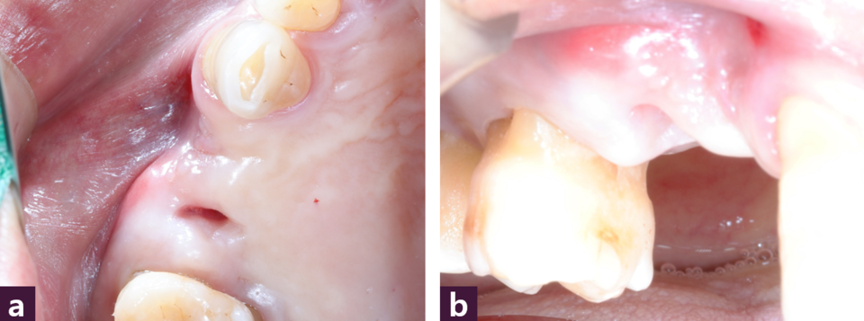 [그림 4] #14 부위 술 전 구강 내 사진  ⓐ 교합면, ⓑ 협측면