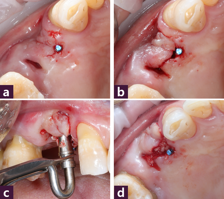 [그림 5] External pocket technique 시행 과정ⓐ Magic Guide Pin 삽입 후 CBCT 촬영  ⓑ semilunar incision을 가한 모습  ⓒ 협측 결손부에 골이식  ⓓ 협측 함몰부가 개선된 모습