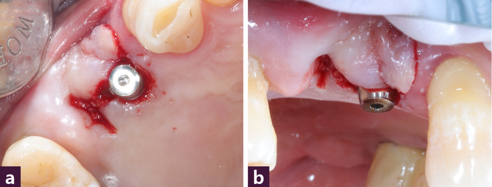 [그림 6] MagiCore 식립 후 구강 내 사진  ⓐ 교합면, ⓑ 협측면