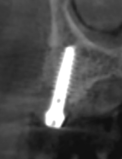 [그림 7] MagiCore 식립 후 CBCT 이미지