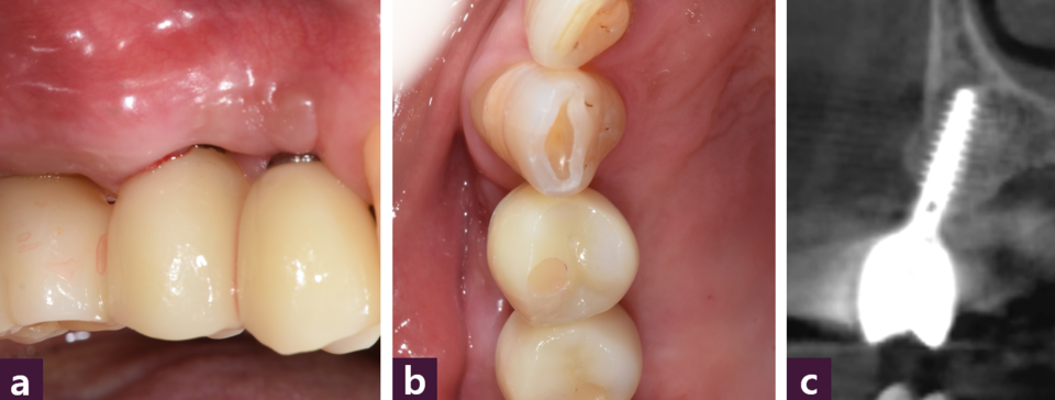 [그림 8] 최종 보철물 장착ⓐ 구강 내 협측면 사진, ⓑ 구강 내 교합면 사진, ⓒ CBCT