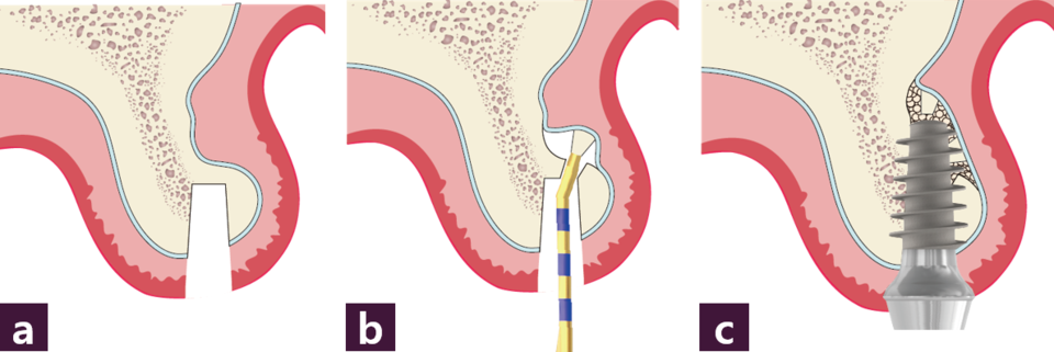 [그림 9] Internal pocket technique의 모식도ⓐ 식립구 형성, ⓑ 식립구 안쪽으로 골이식을 위한 공간 형성, ⓒ 골이식 후 MagiCore 식립