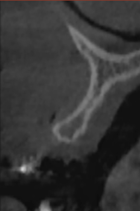 [그림 12] #22 부위 술 전 CBCT 이미지