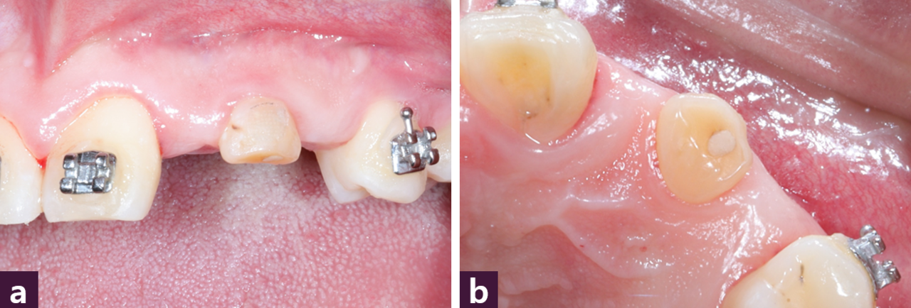 [그림 13] 술 전 구강 내 사진 ⓐ 순측면  ⓑ 교합면