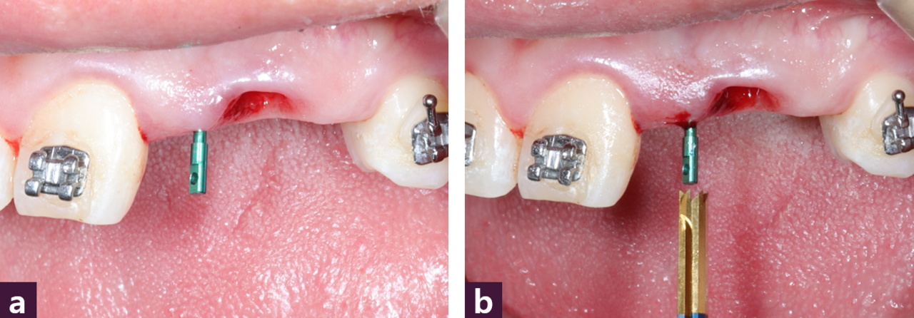 [그림 14] Drillling 시행ⓐ Magic Guide Pin 삽입 후 CBCT 촬영, ⓑ Magic Guide Pin을 따라 drilling 시행