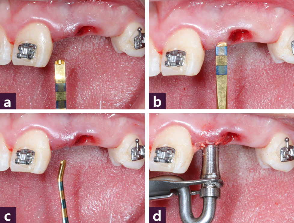 [그림 15] 골이식 과정ⓐ~ⓒ Magic Periosteal Elevator 사용, ⓓ 식립구 안쪽으로 골이식 시행