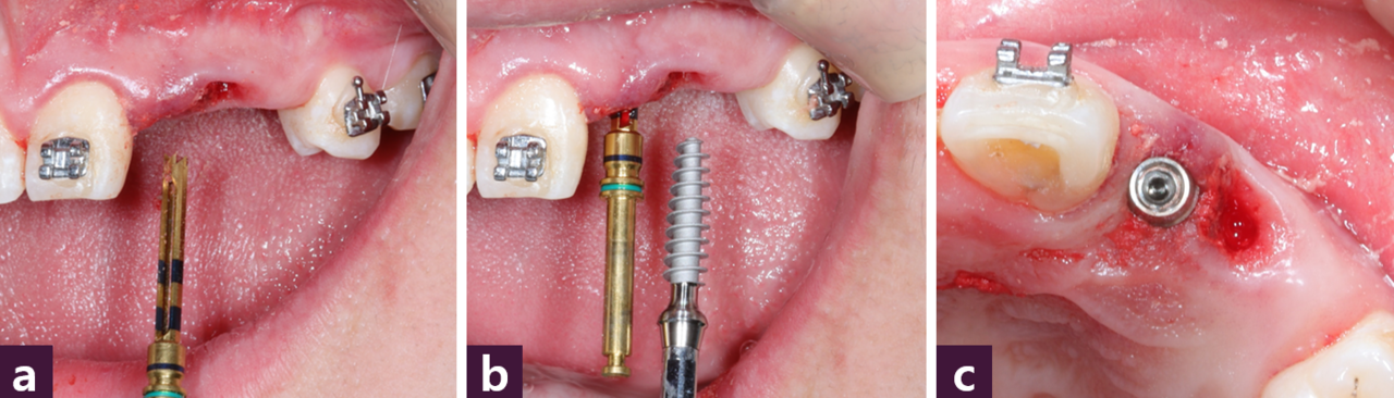 [그림 16] MagiCore 식립 과정ⓐ 계획된 길이에 맞추어 식립구 재형성, ⓑ 방향을 유지하며 MagiCore 식립, ⓒ 식립 후