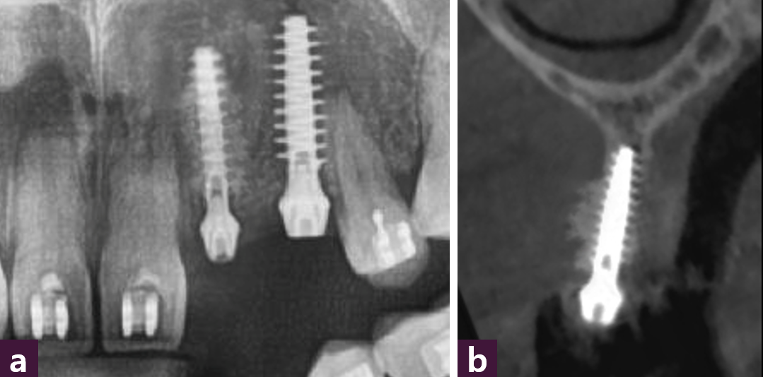 [그림 17] 식립 직후 ⓐ 파노라마, ⓑ CBCT