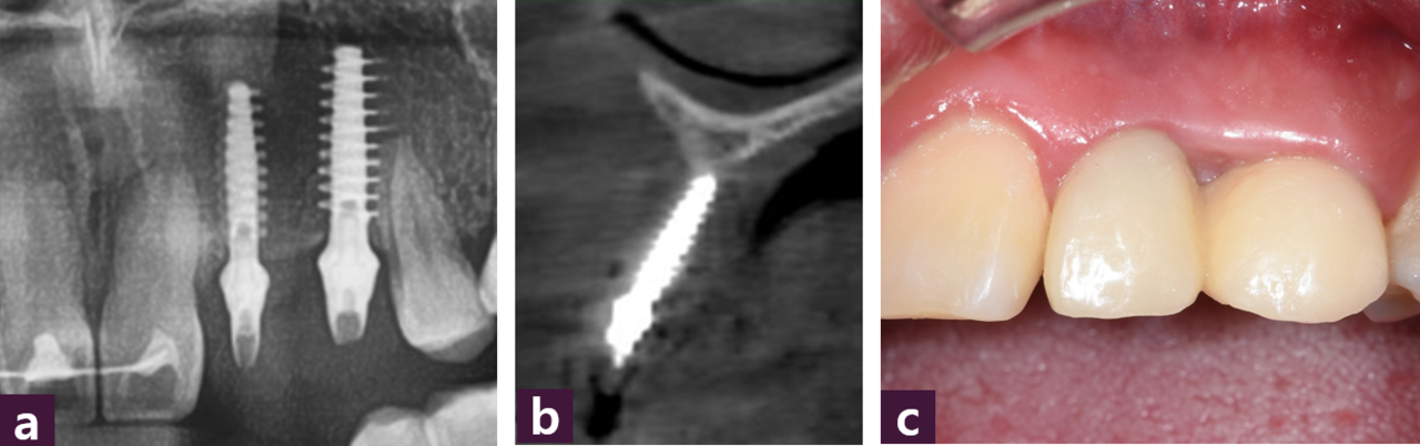 [그림 18] 식립 5개월 후 ⓐ 파노라마ⓑ CBCT ⓒ 구강 내 사진