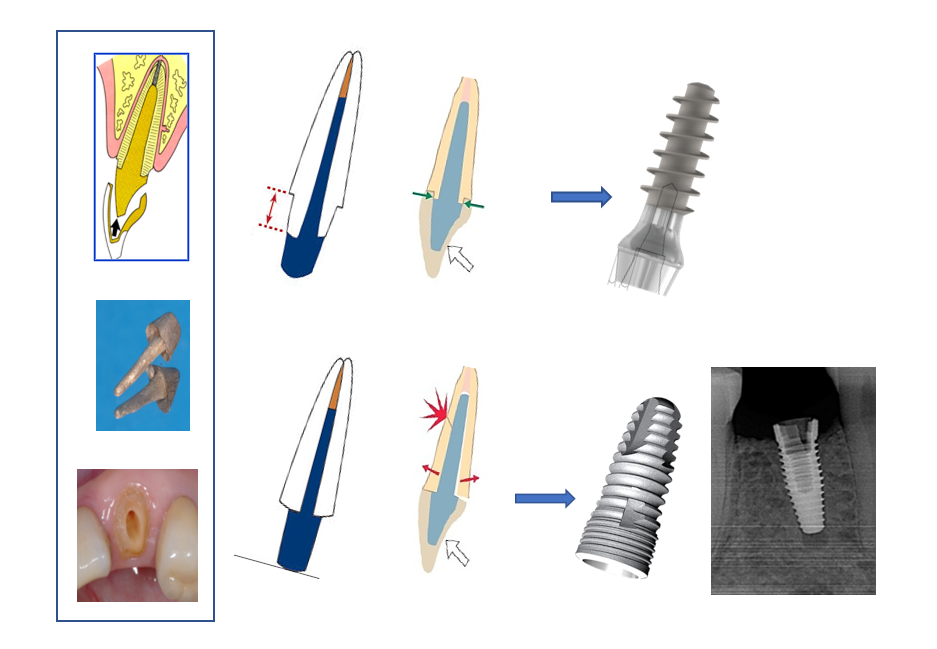 [그림 3] Ferrule effect