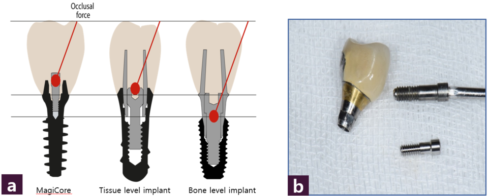 [그림 4] MagiCore의 나사ⓐ 나사에 가해지는 측방력 비교, ⓑ 나사 크기 비교 (상: 일반 나사, 하: MagiCore 나사)