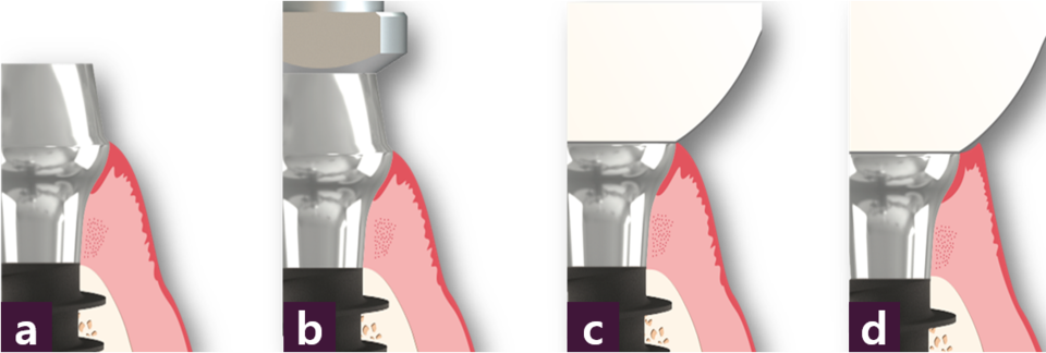 [그림 5] MagiCore에서의 치주 상태ⓐ 식립 후, ⓑ impression coping 체결 시, ⓒ 최종 보철물 체결 직후, ⓓ 최종 보철물 체결 수 주 후