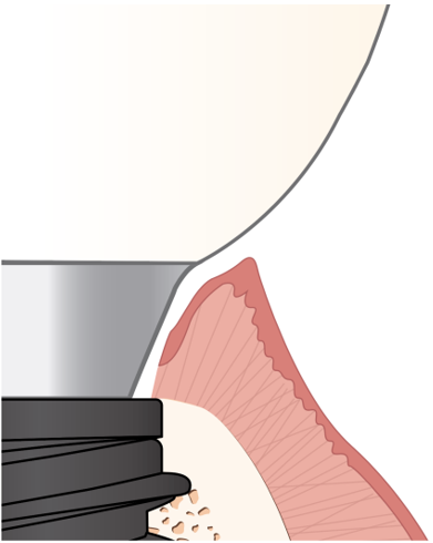 [그림 6] 최종 보철 장착 시 결합 조직이 분리된 상태