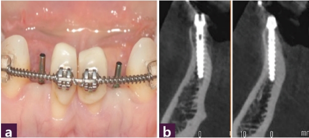 [그림 8] 최소침습적 임플란트 식립   ⓐ Magic GPS를 사용한 구강내 사진, ⓑ 식립 후 CBCT