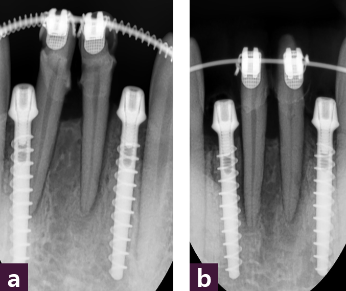 [그림 9] 치근 방향 교정