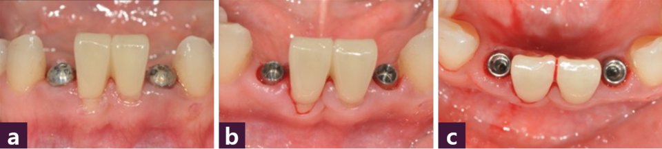 [그림 10] margin 정리  ⓐ Healing cap 체결, ⓑ margin이 정리된 순측면 사진, ⓒ margin이 정리된 교합면 사진