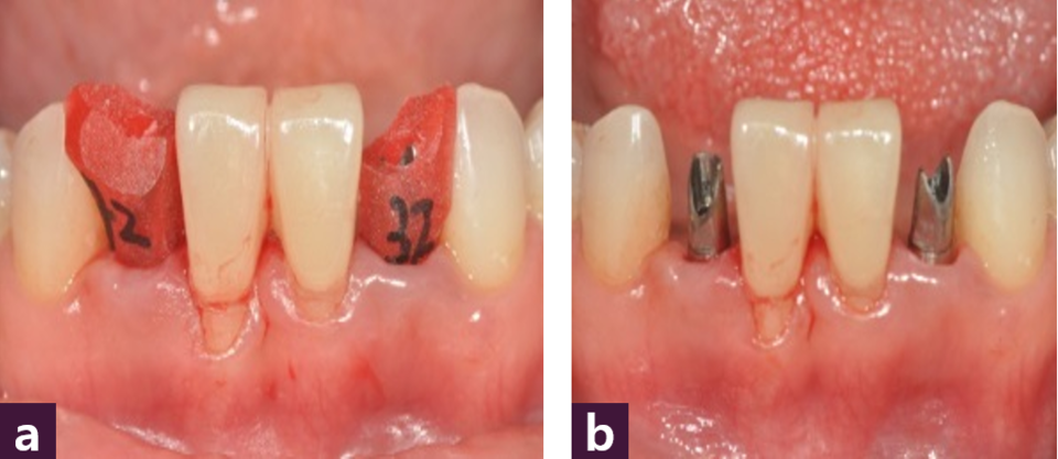 [그림 11] 최종 보철물 체결 과정  ⓐ Jig를 체결한 구강 내 사진, ⓑ Short Abutment을 체결한 구강 내 사진